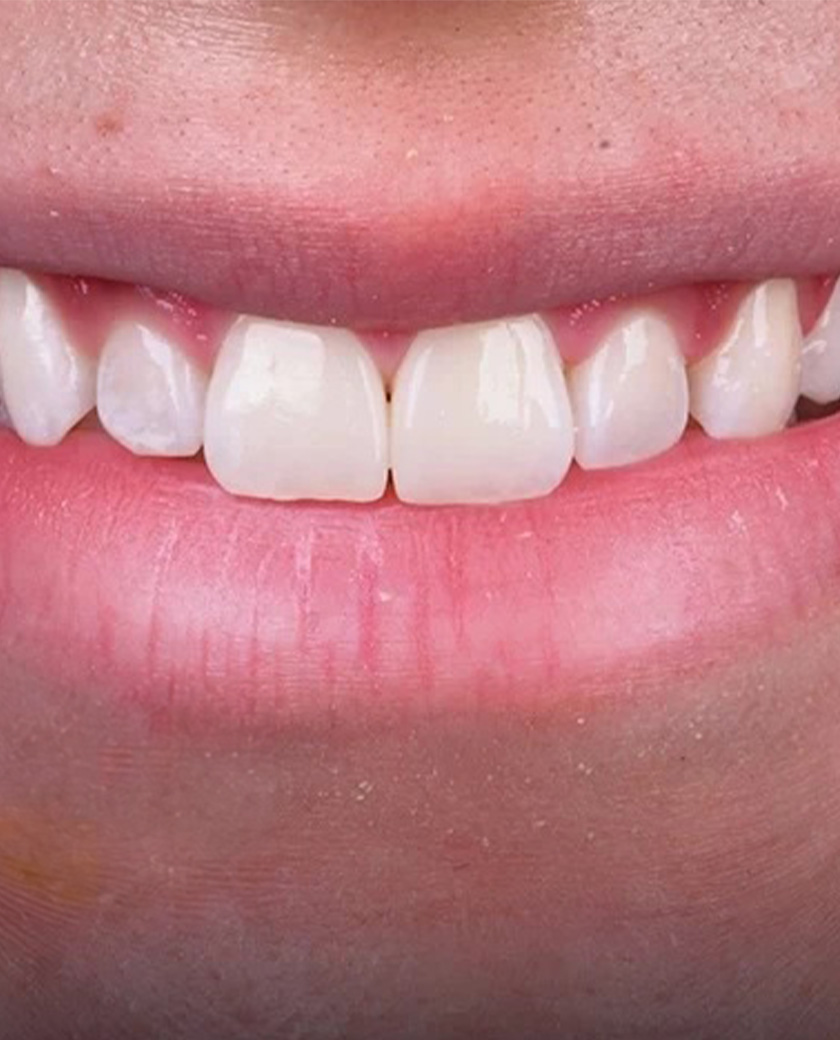 بعد الحشوات التجميلية